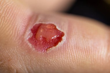 Yanık üstüne yara, kırmızı açık yara.