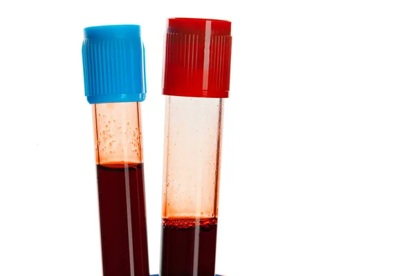 Fechar o exame do tubo sanguíneo. Conceito diagnóstico de Coronavirus 2019-ncov — Fotografia de Stock