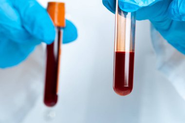 Doktorlar mavi eldiven giyer, test tüpünü kanla doldururlar.