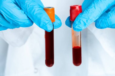 Doktorlar mavi eldiven giyer, test tüpünü kanla doldururlar.