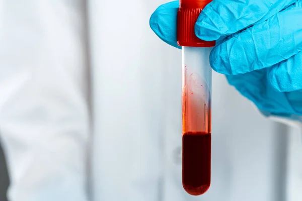 Doctors hands in blue gloves keep test tube with a blood — Stock Photo, Image