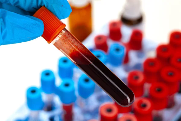 Σωλήνας εξέτασης αίματος για ανάλυση. 2019-nCoV λοίμωξη από τον ιό καταγωγής Wuhan, Κίνα — Φωτογραφία Αρχείου