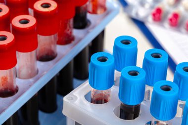 Analiz için kan testi tüpü. 2019-NCoV virüs enfeksiyonu Çin, Wuhan 'dan kaynaklanıyor.