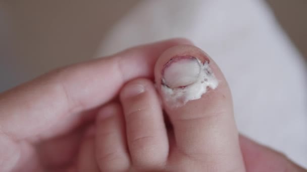 Moeder verbandt haar kinderen met een grote teen. Close-up foto van kinderen voet met verbonden vinger. Eerste hulp in geval van kleine binnenlandse schade. — Stockvideo