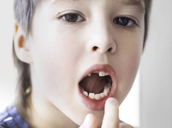 小孩子嘴上有一排牙齿 露出了洞 刚才一个门牙掉了出来 牙医用牙龈的近照 — 图库照片