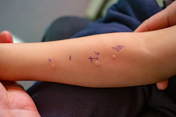 Teste Alergia Picada Pele Braço Uma Criança Resultados Positivos Close — Fotografia de Stock