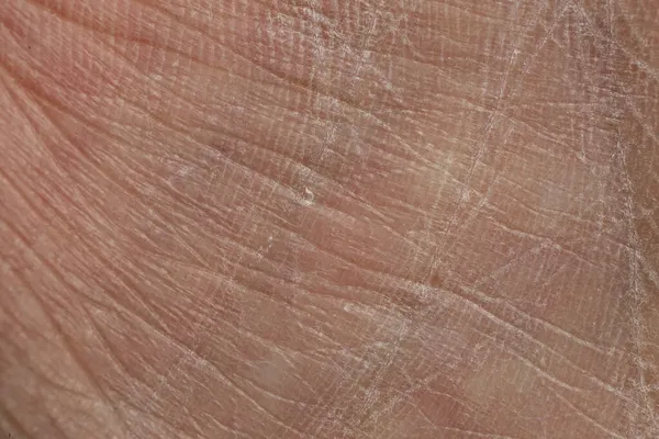 Getrocknete Haut Auf Der Handfläche Makrotextur — Stockfoto