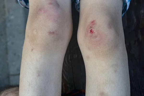 Child Knees Many Scars Bruises Abrasions Representing Normal Childhood Lot — Fotografia de Stock