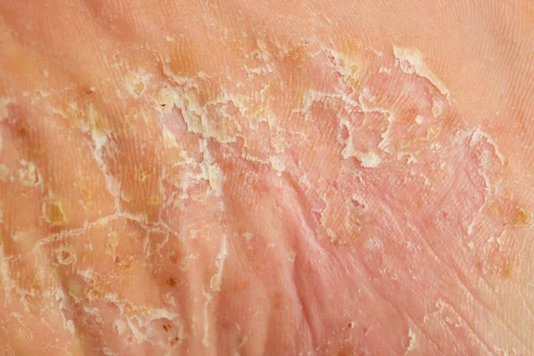 Súlyos Pustularis Psoriasis Elváltozások Talp Láb — Stock Fotó