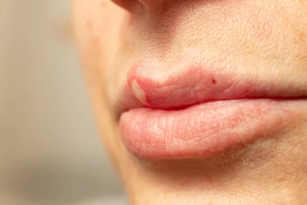 女性嘴唇带有病毒疱疹脓包 疱疹表现 场深度浅大 — 图库照片