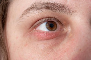 Beyaz bir kadının göz kapağında harici Chalazion veya Hordeolum (Stye) bulunur.