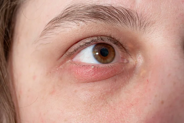 白种人妇女眼睑上的外层粉刺或角蛋白 Stye — 图库照片