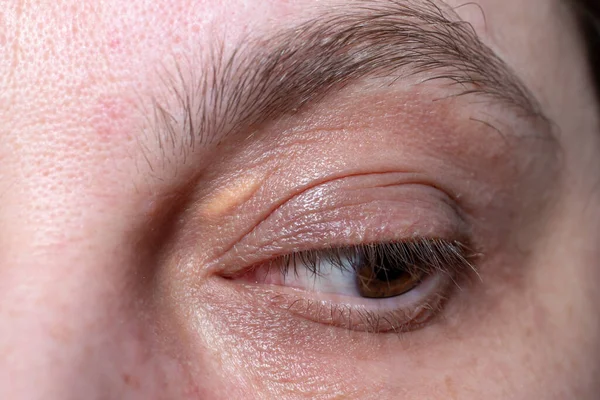 Xanthelasma Erhöhtes Gelbliches Wachstum Der Augenlider Makroschuss — Stockfoto