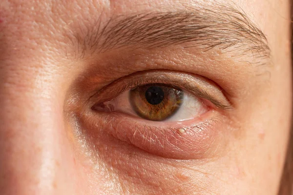Beyaz bir kadının göz kapağı üzerinde dış Chalazion veya Hordeolum (Stye) ve Xanthelasma (göz kapaklarında sarımsı büyüme), makro çekim