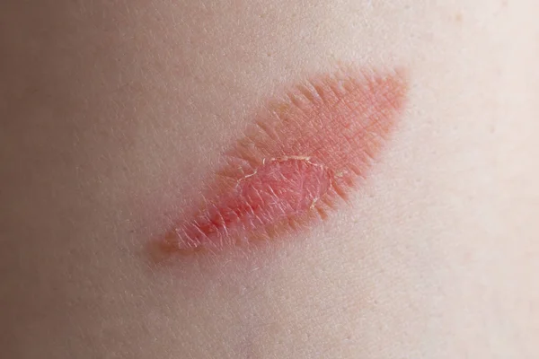 女性前臂上的叶状灼伤 宏观皮肤纹理 — 图库照片
