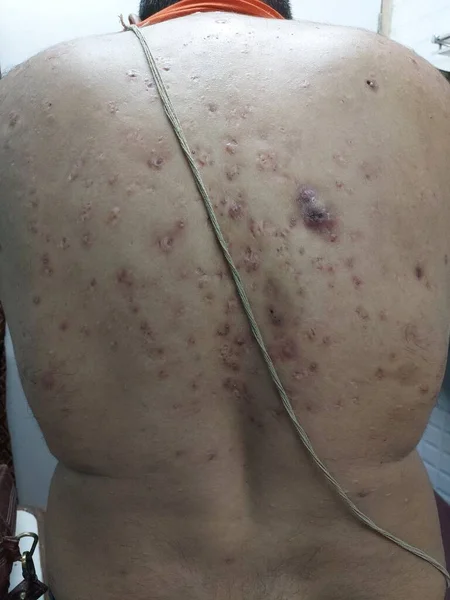 Hindu bir hastanın sırtında deri lezyonu kist ve yara izi oluşumlu tıbbi bir terim..