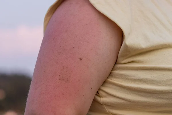 Podrażnione oparzenia słoneczne na ramieniu kobiety latem — Zdjęcie stockowe