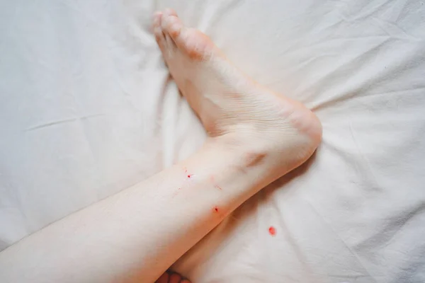 Mușcăturile Pisică Sângerările Glezne Pot Provoca Rabie Tetanos Conceptul Asistență — Fotografie, imagine de stoc