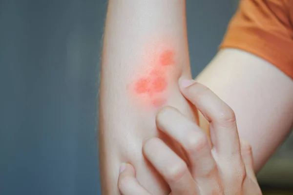 Ramię Kobiety Zadrapane Czerwoną Wysypką Powodu Reakcji Alergicznej Lub Użądlenia — Zdjęcie stockowe
