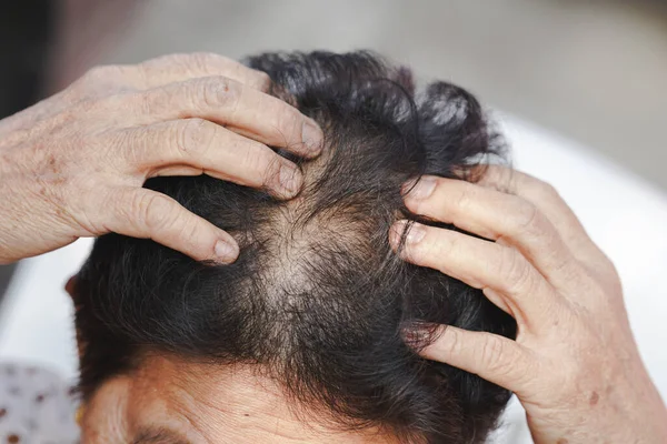 Elderly Women Have Thinning Hair Due Hair Loss —  Fotos de Stock