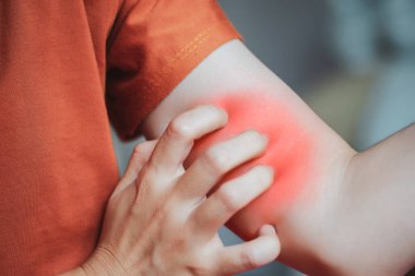 Bir şey ya da böcek ısırığına alerjisi olan bir kadın kolunu kaşıyor..