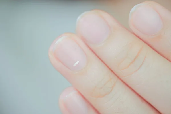 White Spots Finger Nails Called Leukonychia Reveal Emergence Health Problems — Stock Photo, Image