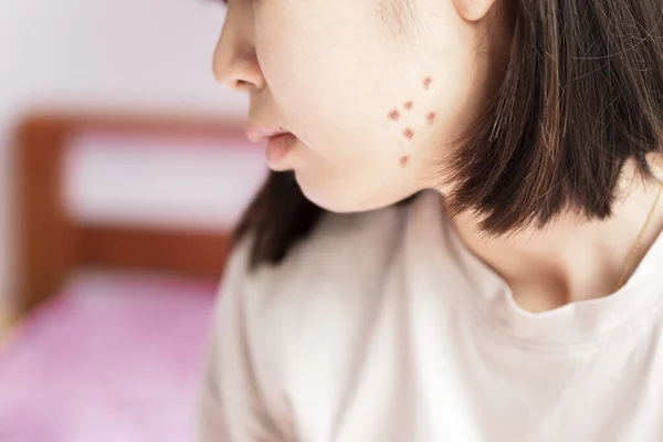 女性の顔ににきび傷跡 スキンケアのコンセプト — ストック写真