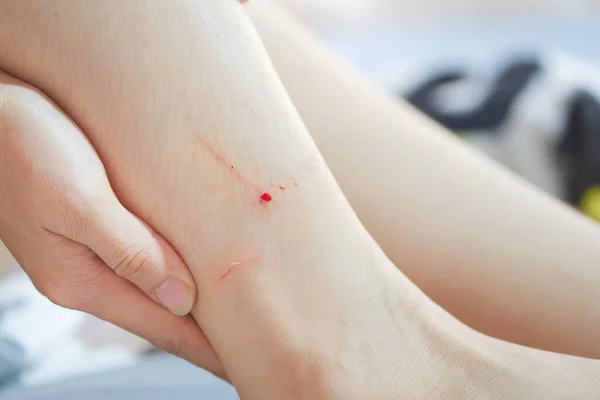 Bleeding Wound Ankle Caused Cat Bite — Zdjęcie stockowe