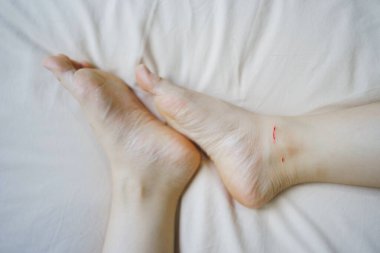 Bleeding wounds on the ankles, due to being bitten by a cat.