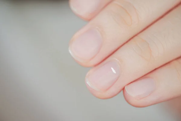 White Spots Finger Nails Called Leukonychia Reveal Emergence Health Problems — Stock Photo, Image