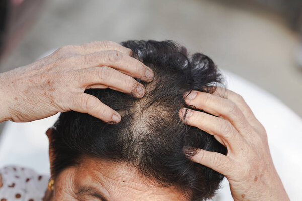 Elderly women have itchy scalp leading to hair loss and thinning.