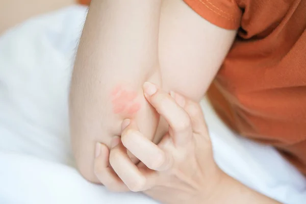 Woman Arms Were Itchy Red Due Insect Bites — Stockfoto