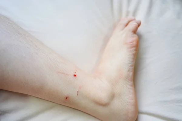 Bleeding Wounds Ankles Due Being Bitten Cat —  Fotos de Stock