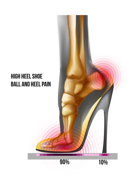 Bal van voet pijn hoge hiel schoen botten gewichtsverdeling. Röntgenskelet realistische anatomie illustratie — Stockvector