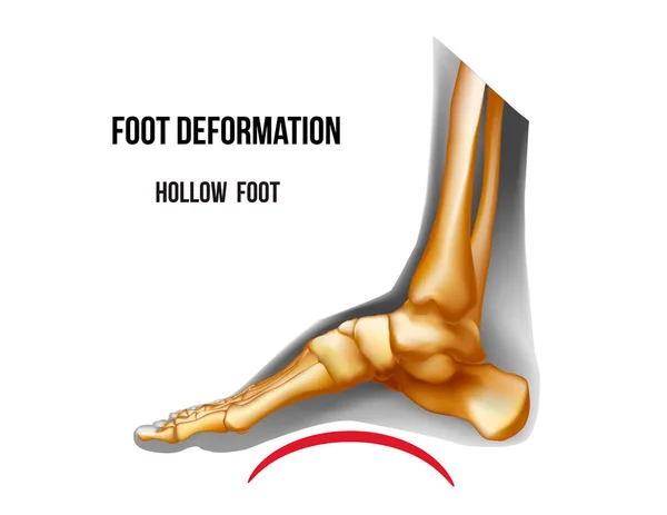 Ayak oyuğu kemer deformasyonu. İskelet iskeleti gerçekçi anatomi çizimi — Stok Vektör