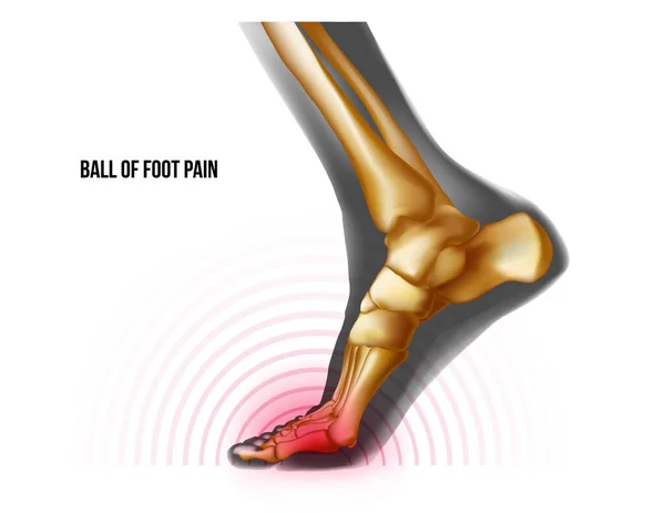 Ball of foot pain bones skeleton realistic anatomy illustration — Stockový vektor