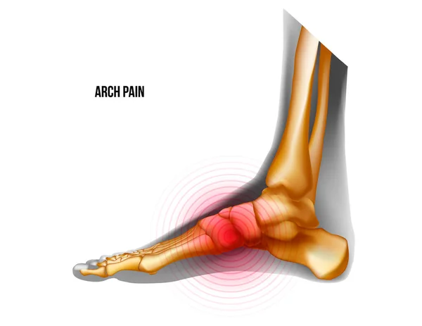 足部疼痛骨头骨骼的弧形写实图解 中间的观点 关节解剖 人的腿现实的黑色和黄色透明骨骼 用于医疗矫形广告 矢量图形