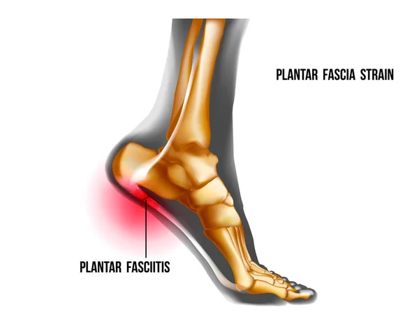 Plantar fasiit iltihaplanması ve yırtılma gerginliği. Ayak ağrısı, gerçekçi anatomi çizimi — Stok Vektör
