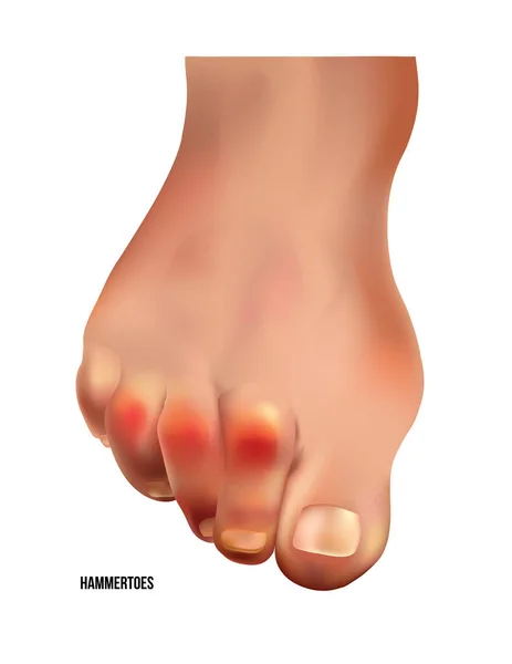 Realistyczne palce młotka ludzkiej nogi z czerwonymi punktami bólu widok z przodu. Wektory Stockowe bez tantiem