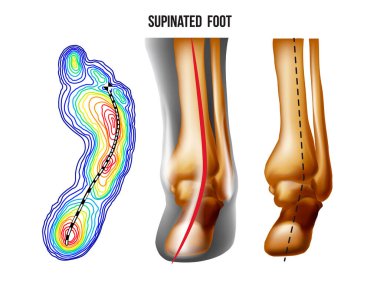 Supinated foot, arch deformation, bottom and back view . Foot weight distribution. clipart