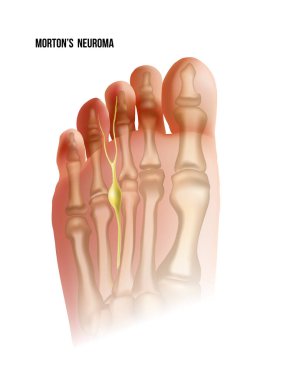 Mortons neuroma. Foot pain strain bottom view. Realistic anatomy illustration clipart