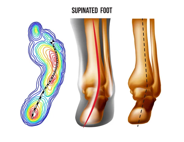 Pied supporté, déformation de l'arche, vue du bas et de l'arrière. Répartition du poids des pieds. — Image vectorielle