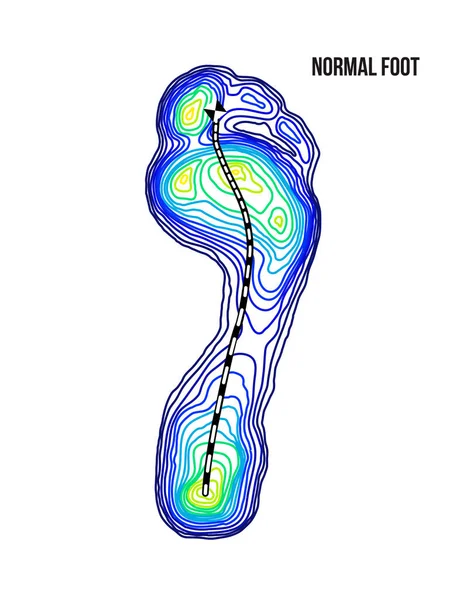 Rozložení hmotnosti nohou. Normální termální pohled na spodní část oblouku. Žádná deformace. — Stockový vektor