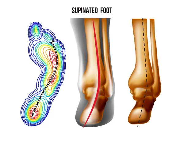 Abgestützter Fuß, Bogendeformation, Po-und Rückansicht. Fußgewichtsverteilung. Stockillustration