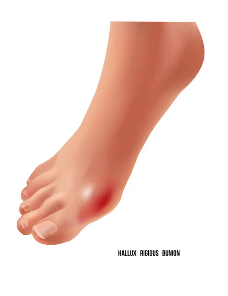 Arthritischer Hallux rigidus bunion rheumatoide Gelenkschmerzen, Draufsicht. Stockvektor