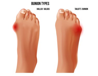 Artritik terziler nasır ve hallux valgus ayak nasır romatoid eklemler, üst görünüm.