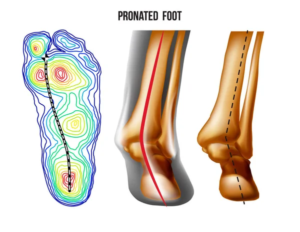 Ausgeprägter Fuß, Bogenverformung, Unter- und Rückansicht. Fußgewichtsverteilung. Vektorgrafiken