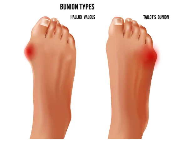 Artritic tailors bunion and hallux valgus foot bunion rheumatoid sore joints, top view. 免版税图库矢量图片