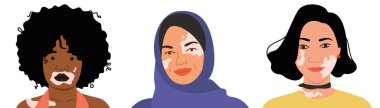 Farklı milletlerden ve görünümlerden Vitiligo 'ya sahip bir grup kadın. Düz vektör çizimi. Deri hastalığı, vücut pozitifliği, kendini kabullenme, güzellik..