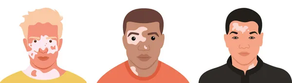 Farklı milletlerden ve görünüşlerden Vitiligo 'ya sahip bir grup adam. Düz vektör çizimi. Deri hastalığı, vücut pozitifliği, kendini kabullenme..
